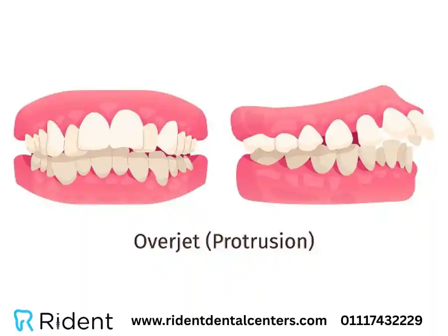 مدة تقويم الأسنان البارزة و8 أنواع مختلفة للتقويم لا تعلمها